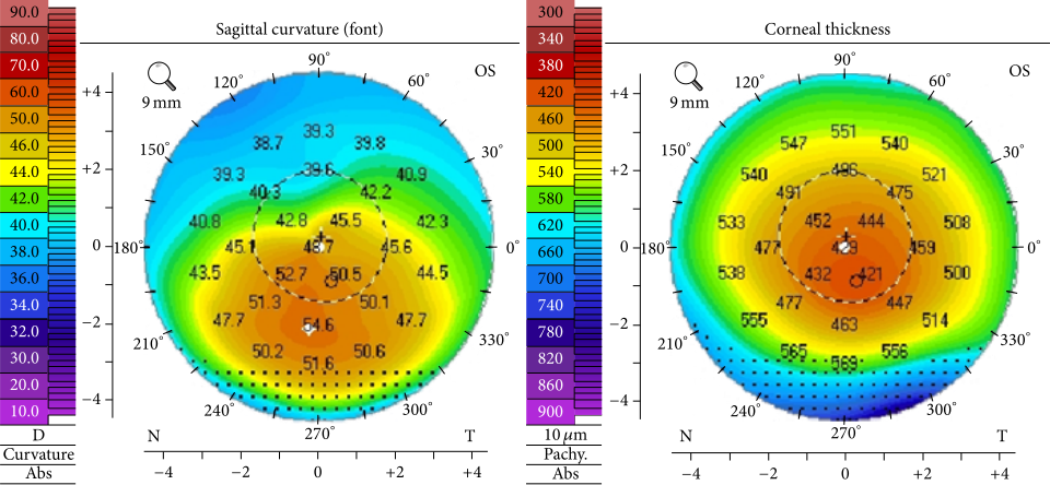 Hoornvliesscan bij keratoconus: links de kromming, rechts de dikte van het hoornvlies