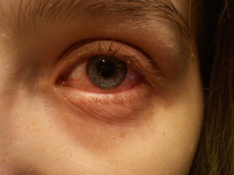 Een oog met een bindvliesontsteking