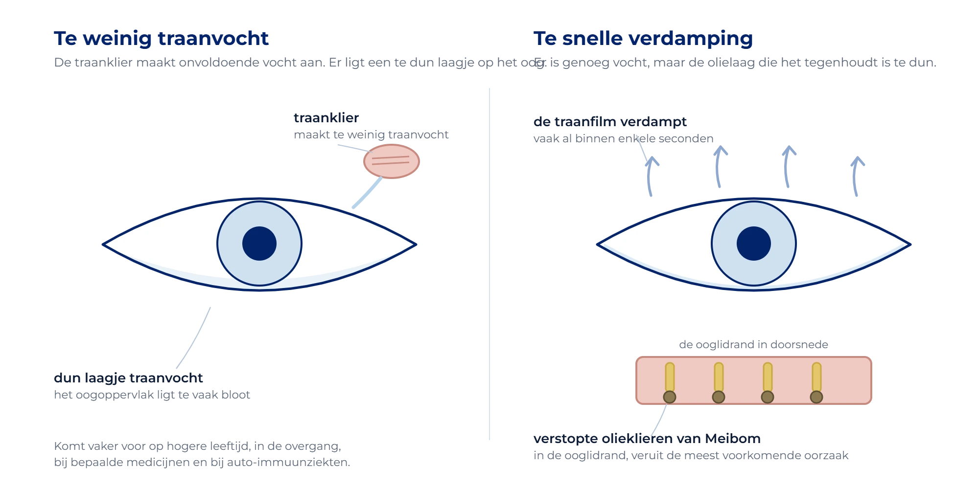 Twee soorten droge ogen: te weinig traanvocht uit de traanklier, of te snelle verdamping door verstopte olieklieren van Meibom in de ooglidrand