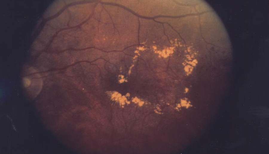 Gele vetachtige neerslag rond de gele vlek bij diabetisch macula-oedeem