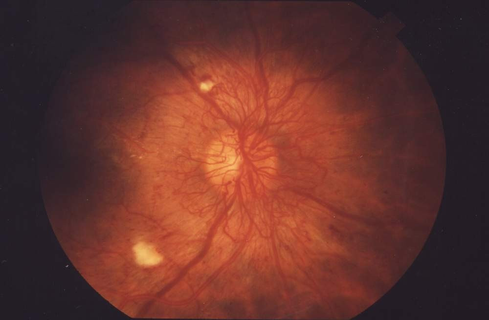 Nieuwe, kwetsbare vaatjes op het netvlies bij proliferatieve diabetische retinopathie