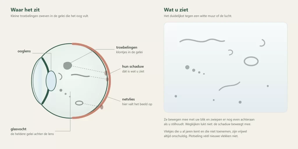 Doorsnede van het oog met troebelingen in het glasvocht die een schaduw op het netvlies werpen, en daarnaast hoe die eruitzien tegen een lichte achtergrond