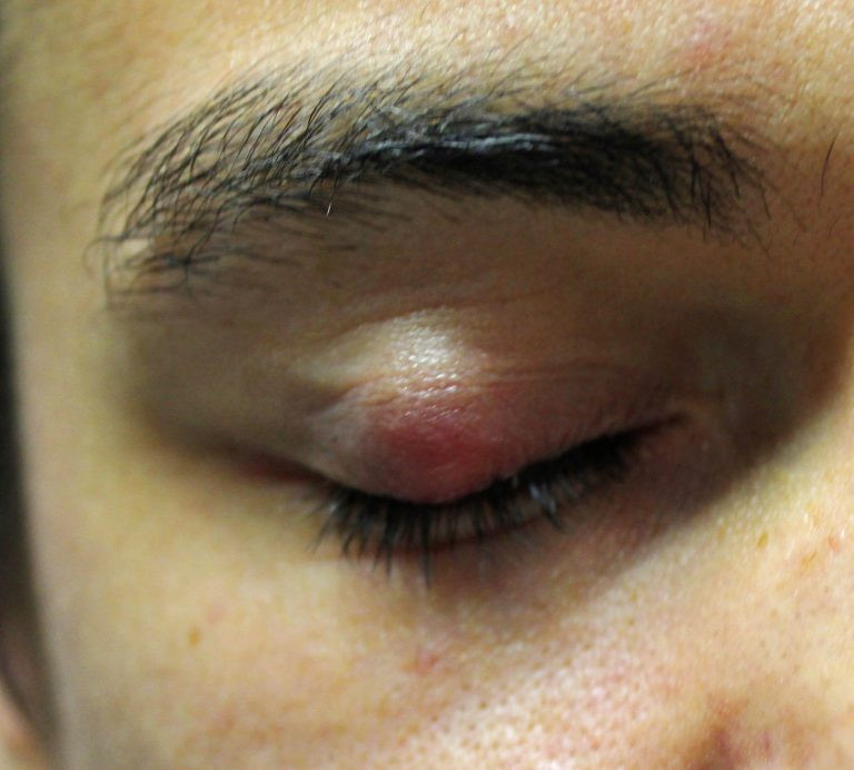Een chalazion: een zwelling dieper in het ooglid