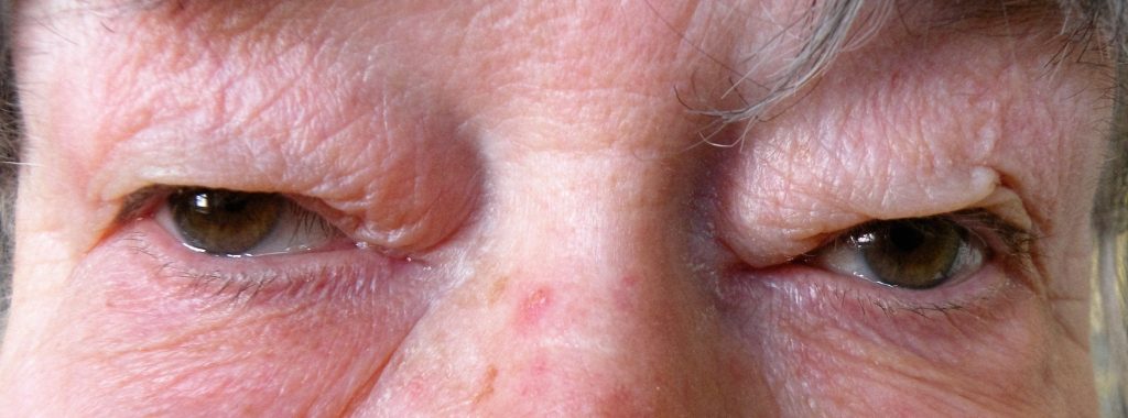 Overtollige huid op de bovenoogleden (dermatochalasis), die over de wimpers hangt