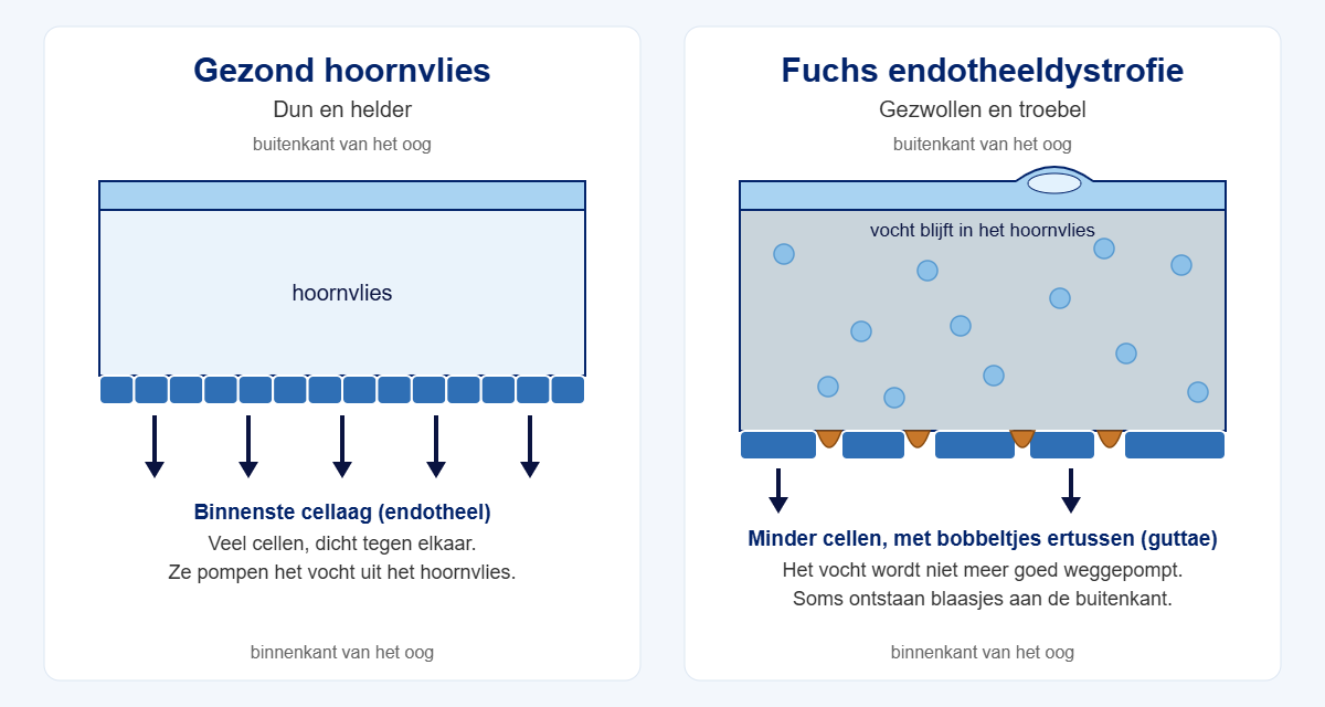 Links een gezond hoornvlies, rechts Fuchs endotheeldystrofie: er zijn te weinig cellen en het hoornvlies houdt vocht vast