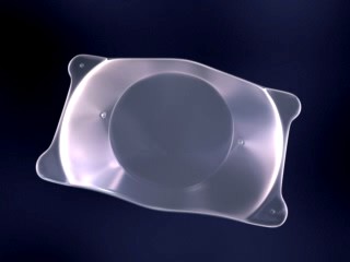 Een implanteerbare lens (ICL): zacht en opvouwbaar. Hij komt achter de iris te liggen, vóór de eigen lens