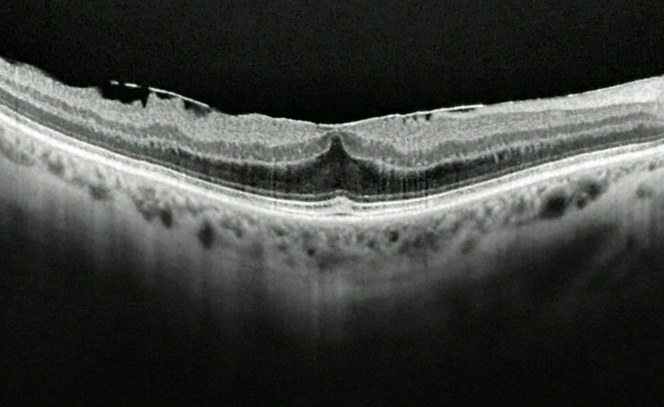 OCT-scan van de gele vlek bij een macula pucker: het vliesje ligt als een heldere lijn op het netvlies, dat geplooid en verdikt is <span class="ozd-bron">Bektelund, CC BY-SA 4.0. Via Wikimedia Commons.</span>