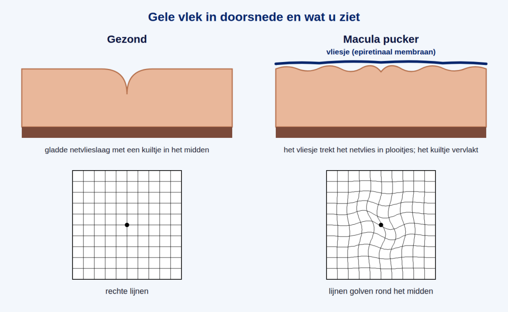 Links een gezonde gele vlek, rechts een macula pucker: het vliesje trekt het netvlies in plooitjes en rechte lijnen gaan golven