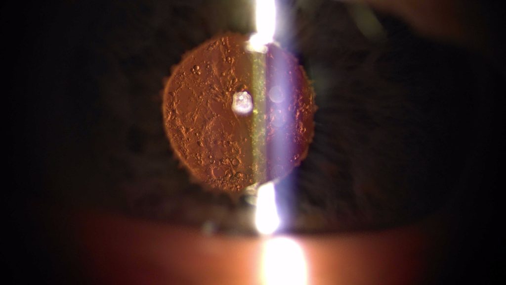 Nastaar bij licht van achteren: kleine bolletjes van lenscellen (parels van Elschnig) op het lenskapsel achter de kunstlens