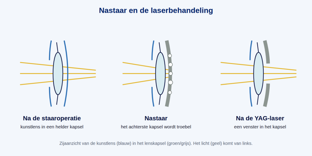 Nastaar: het kapsel achter de kunstlens wordt troebel. Met de YAG-laser wordt er een venster in gemaakt
