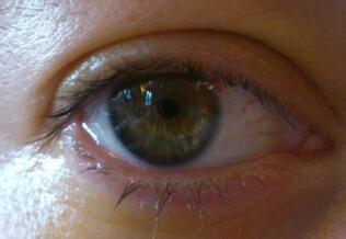 Een oog met een extra kunstlens vóór de eigen lens. De lens is van buitenaf nauwelijks te zien