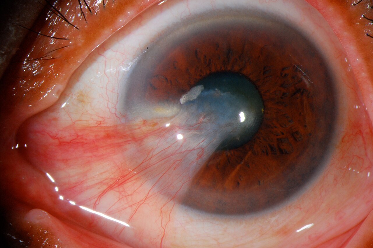 Pterygium: een vliesje met bloedvaatjes groeit vanaf de neuskant over het hoornvlies